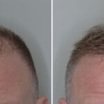 Hair Transplant Before and After Photos in Miami, FL, Patient 7973