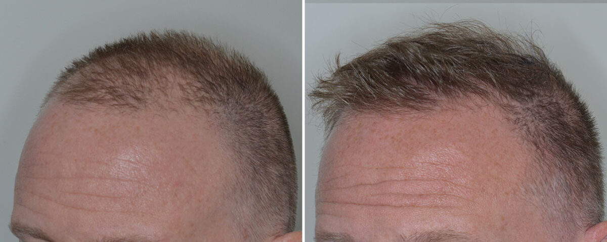 Hair Transplant Before and After Photos in Miami, FL, Patient 7973