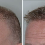 Hair Transplant Before and After Photos in Miami, FL, Patient 7973