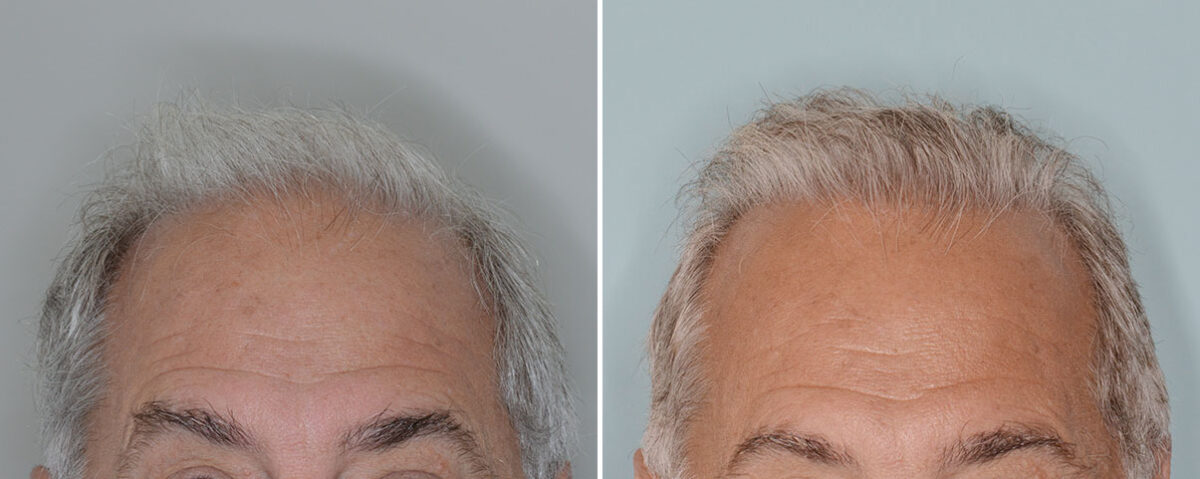 Hair Transplant Before and After Photos in Miami, FL, Patient 8004