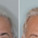 Hair Transplant Before and After Photos in Miami, FL, Patient 8004