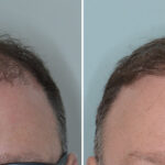 Hair Transplant Before and After Photos in Miami, FL, Patient 8008