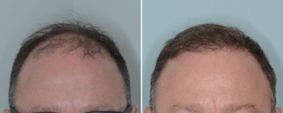 Hair Transplant Before and After Photos in Miami, FL, Patient 8008
