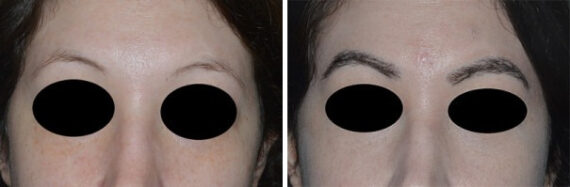 Eyebrow Transplant Before and After Photos in Miami, FL, Patient 2728