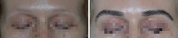 Eyebrow Transplant Before and After Photos in Miami, FL, Patient 8050
