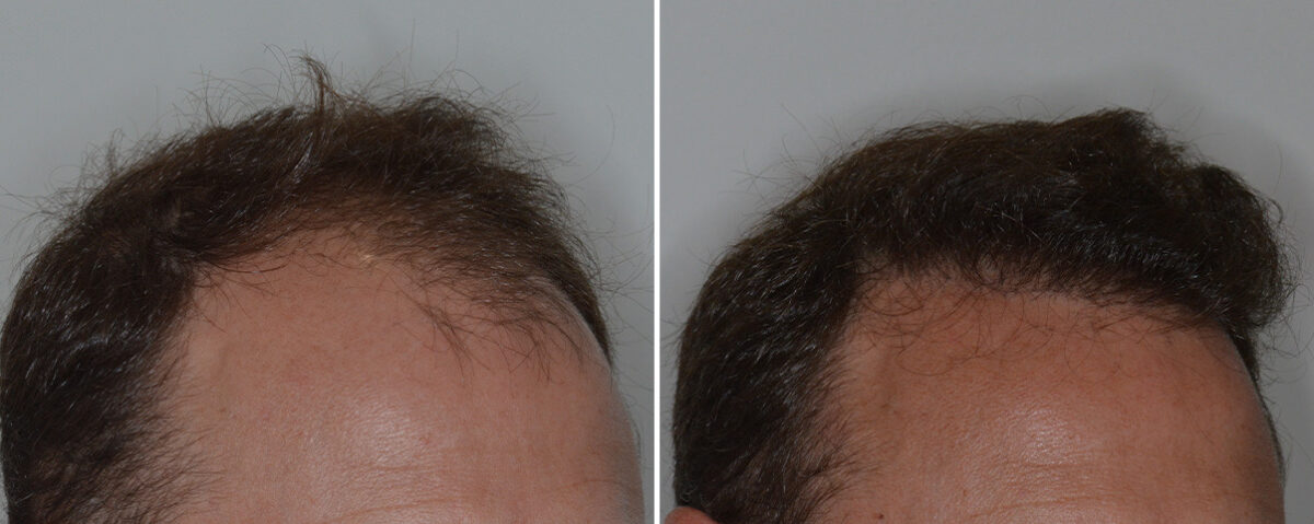 Hair Transplant Before and After Photos in Miami, FL, Patient 8068