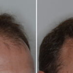 Hair Transplant Before and After Photos in Miami, FL, Patient 8068