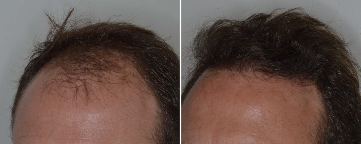 Hair Transplant Before and After Photos in Miami, FL, Patient 8068