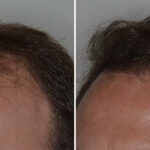 Hair Transplant Before and After Photos in Miami, FL, Patient 8068