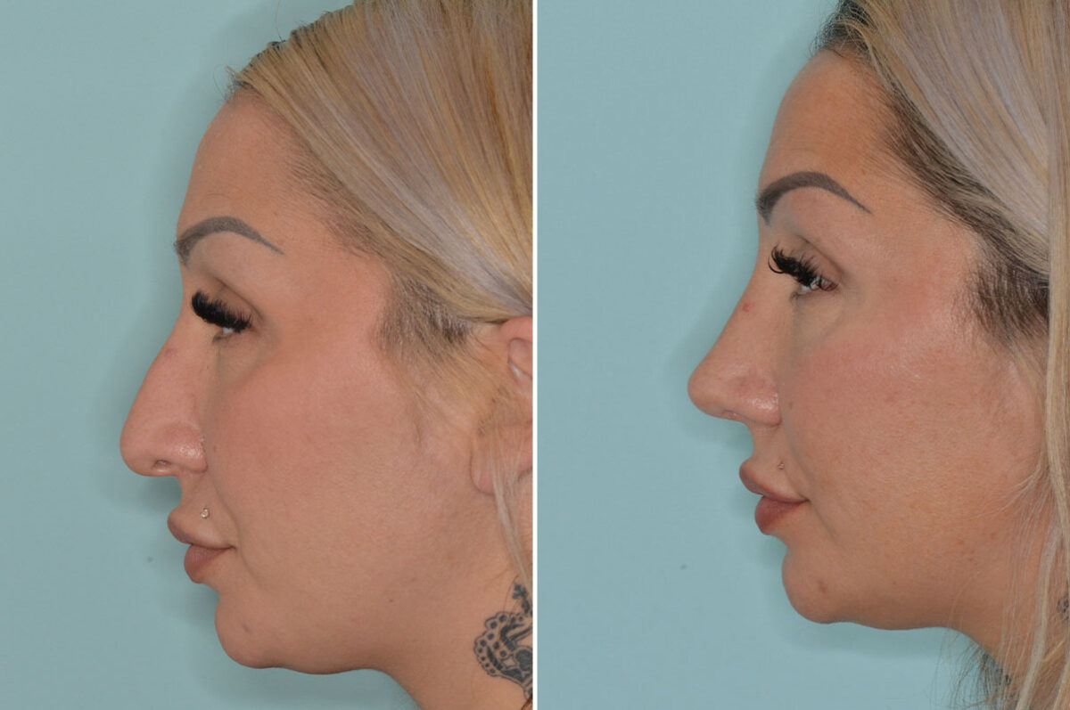 Rhinoplasty Before and After Photos in Miami, FL, Patient 8078