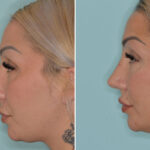 Rhinoplasty Before and After Photos in Miami, FL, Patient 8078