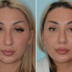 Rhinoplasty Before and After Photos in Miami, FL, Patient 8078