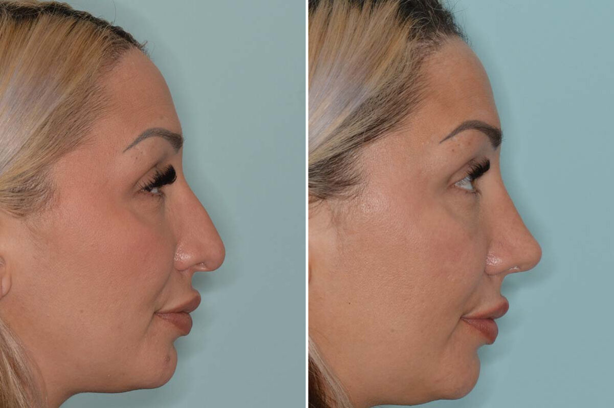 Rhinoplasty Before and After Photos in Miami, FL, Patient 8078