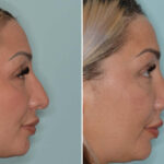 Rhinoplasty Before and After Photos in Miami, FL, Patient 8078