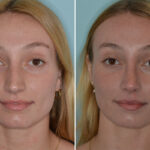 Rhinoplasty Before and After Photos in Miami, FL, Patient 8108