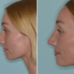 Rhinoplasty Before and After Photos in Miami, FL, Patient 8108