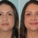 Ethnic Rhinoplasty Before and After Photos in Miami, FL, Patient 8118