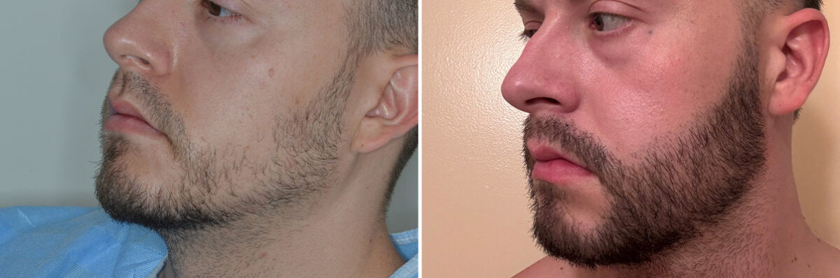 Beard Transplant Before and After Photos in Miami, FL, Patient 8145