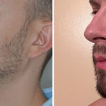 Beard Transplant Before and After Photos in Miami, FL, Patient 8145