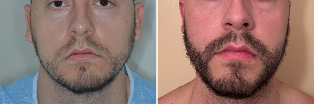 Beard Transplant Before and After Photos in Miami, FL, Patient 8145