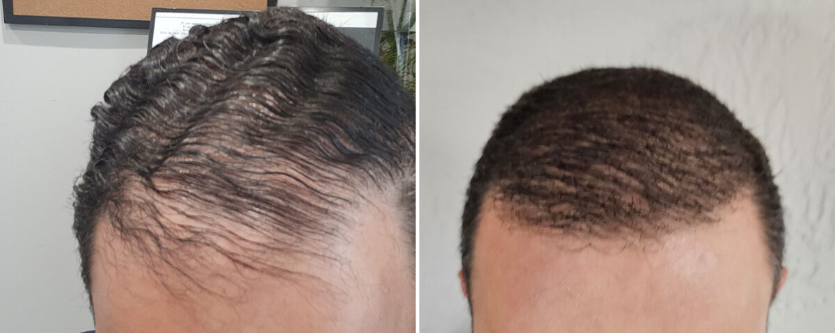 Hair Transplant Before and After Photos in Miami, FL, Patient 8155