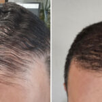 Hair Transplant Before and After Photos in Miami, FL, Patient 8155