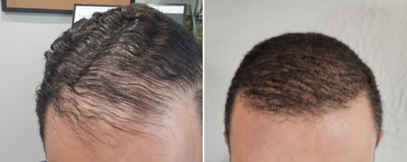 Hair Transplant Before and After Photos in Miami, FL, Patient 8155