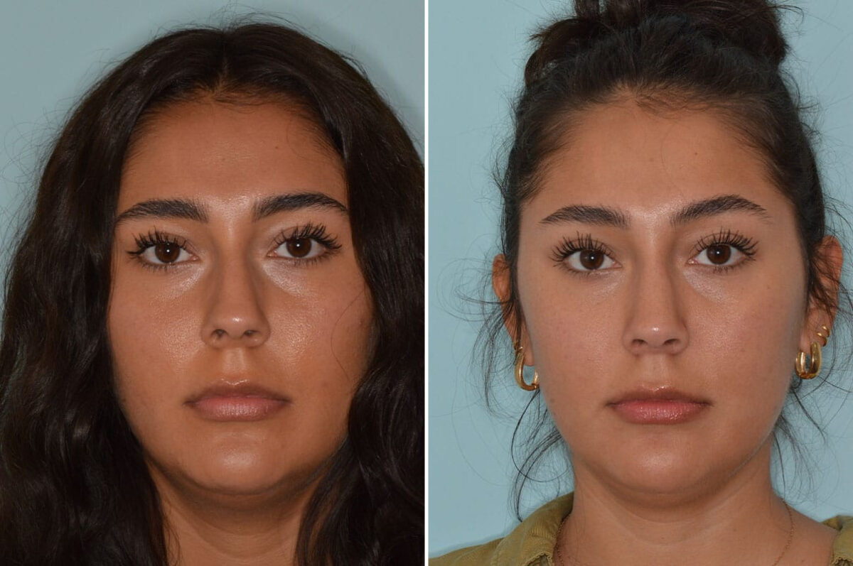 Rhinoplasty Before and After Photos in Miami, FL, Patient 8237