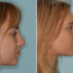 Ethnic Rhinoplasty Before and After Photos in Miami, FL, Patient 8286