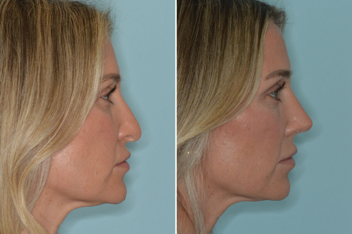 Rhinoplasty Before and After Photos in Miami, FL, Patient 8296