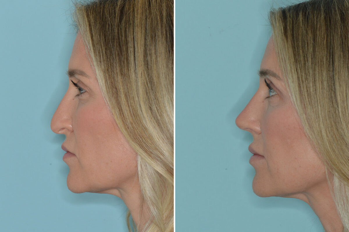 Rhinoplasty Before and After Photos in Miami, FL, Patient 8296