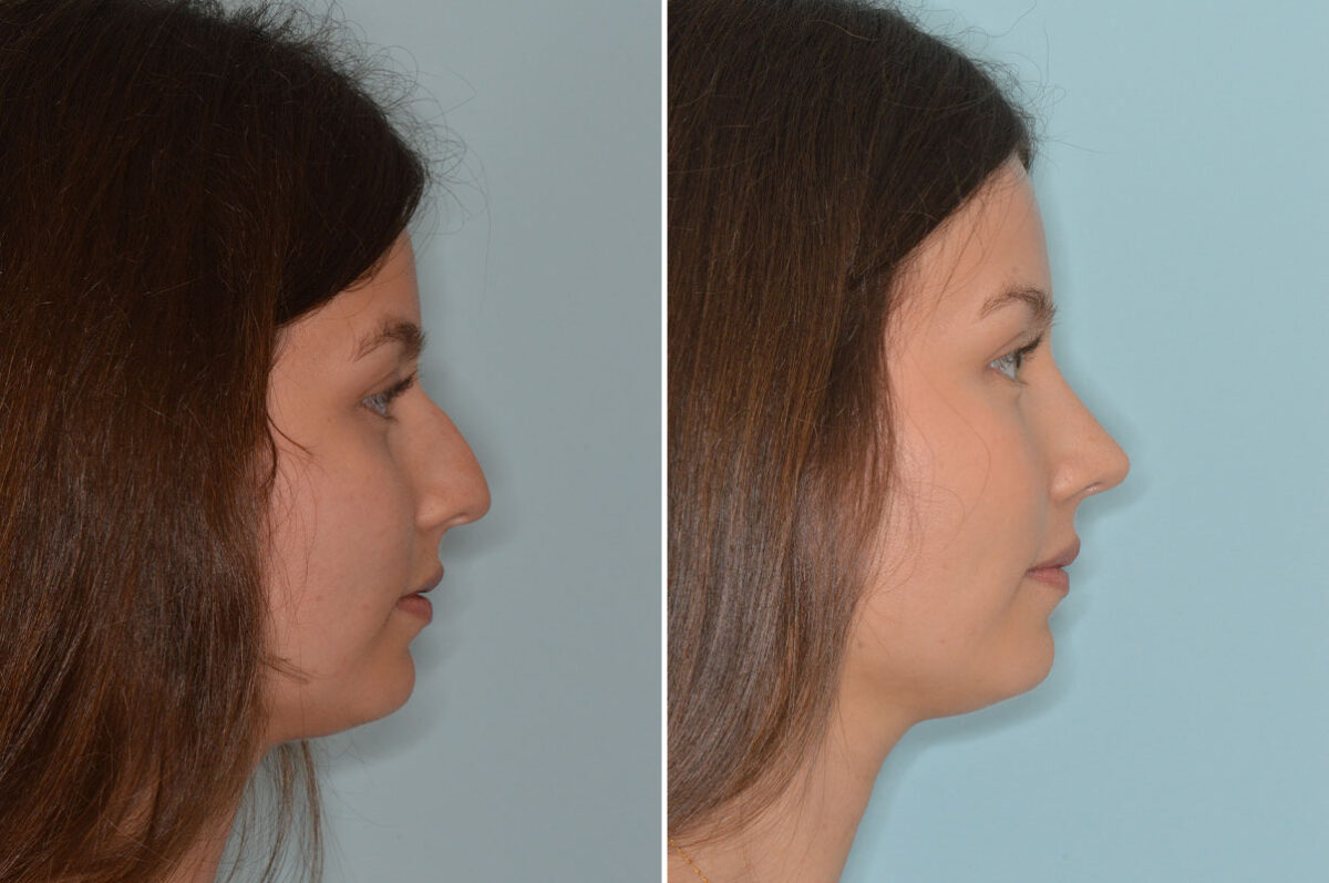 Rhinoplasty Before and After Photos in Miami, FL, Patient 8306
