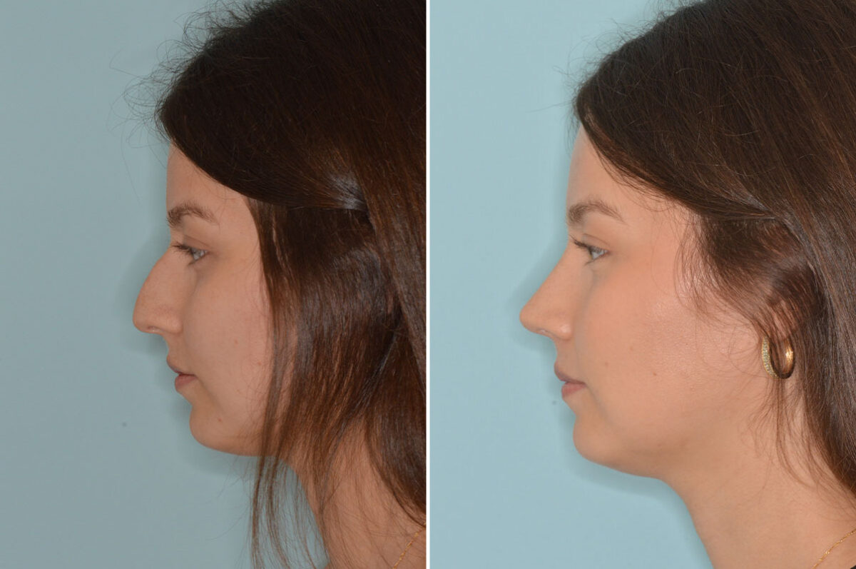 Rhinoplasty Before and After Photos in Miami, FL, Patient 8306