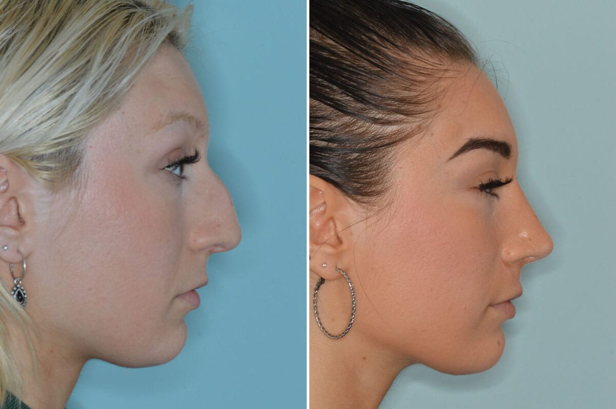 Rhinoplasty Before and After Photos in Miami, FL, Patient 8327