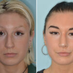 Rhinoplasty Before and After Photos in Miami, FL, Patient 8327