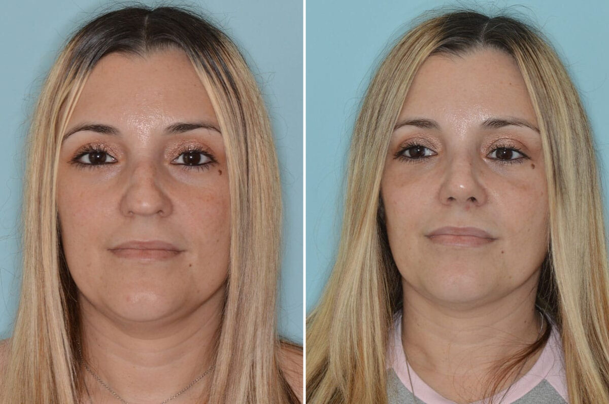 Ethnic Rhinoplasty Before and After Photos in Miami, FL, Patient 8334