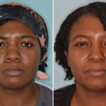 Ethnic Rhinoplasty Before and After Photos in Miami, FL, Patient 8364