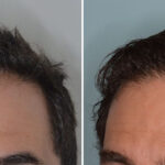Hair Transplant Before and After Photos in Miami, FL, Patient 8378