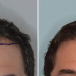 Hair Transplant Before and After Photos in Miami, FL, Patient 8378