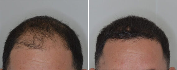 Hair Transplant Before and After Photos in Miami, FL, Patient 8488