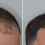 Hair Transplant Before and After Photos in Miami, FL, Patient 8488