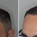 Hair Transplant Before and After Photos in Miami, FL, Patient 8505
