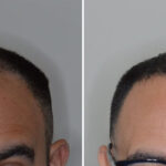 Hair Transplant Before and After Photos in Miami, FL, Patient 8505