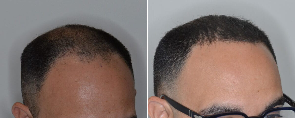 Hair Transplant Before and After Photos in Miami, FL, Patient 8505