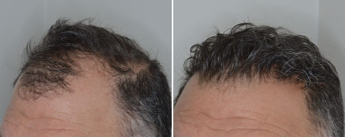 Hair Transplant Before and After Photos in Miami, FL, Patient 8524