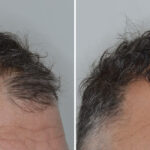 Hair Transplant Before and After Photos in Miami, FL, Patient 8524