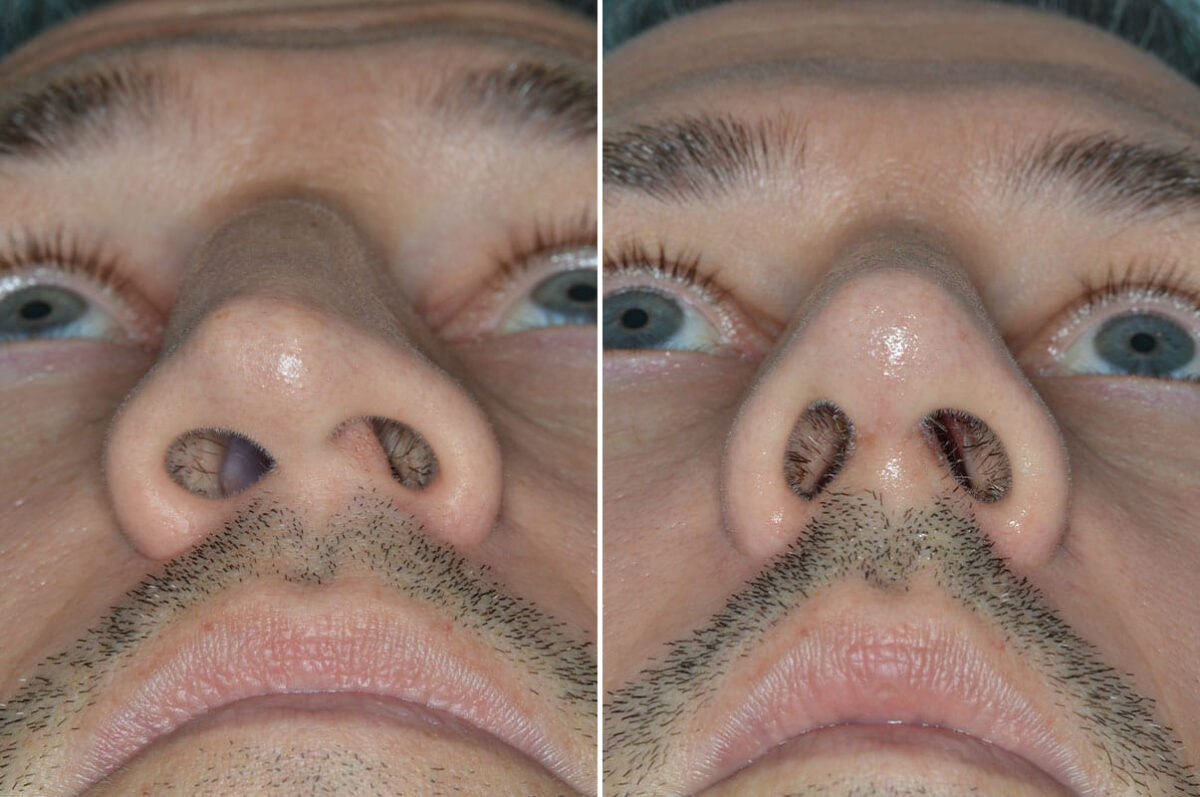 Rhinoplasty Before and After Photos in Miami, FL, Patient 8538
