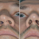Rhinoplasty Before and After Photos in Miami, FL, Patient 8538