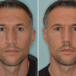 Rhinoplasty Before and After Photos in Miami, FL, Patient 8538