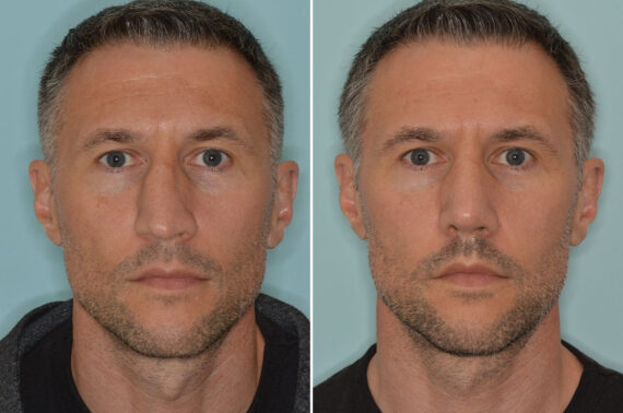 Rhinoplasty Before and After Photos in Miami, FL, Patient 8538